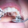 Dental Fillings