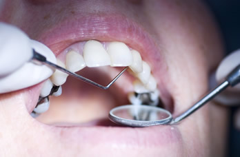 Dental Fillings